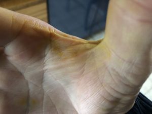 Hand-mit-Kurkumaspuren-300x225 Kurkuma